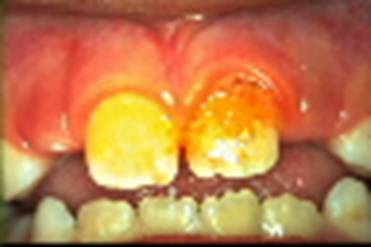 Dental plaque